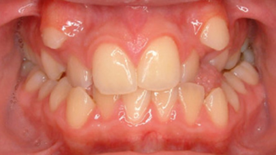 Teeth before dental work with crooked teeth